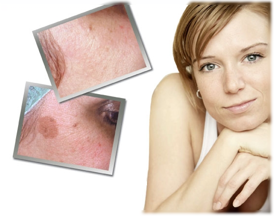 избавиться от пигментных пятен